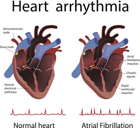 Electrophysiology of Heart and Arrhythmia .